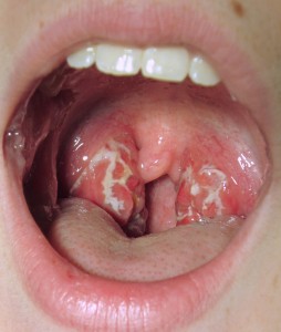 Tonsillite