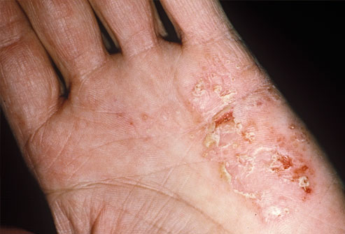 Ci può essere a causa di nervi atopic la dermatite