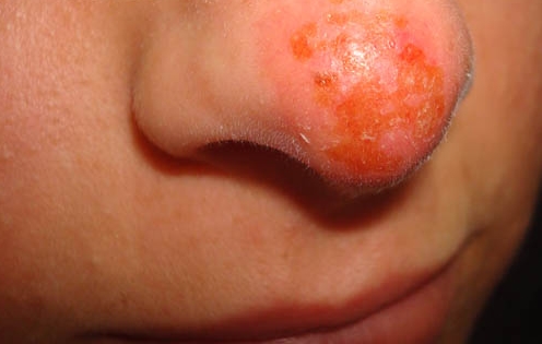 nasal herpes