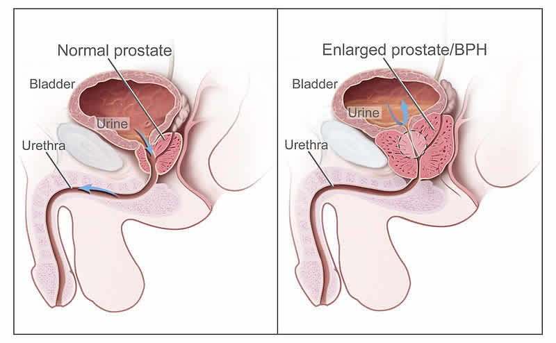 prostata ingrossata rimedi naturali