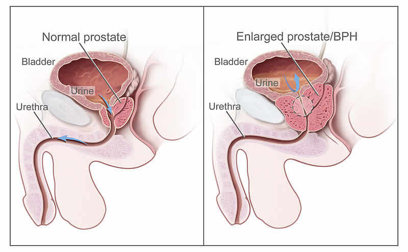 prostata ingrossata dieta e rimedi naturali