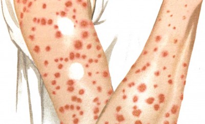 Trattamento di chemioterapia di psoriasi