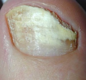 Farmaci contro un fungo di unghie di medicina