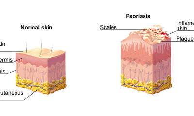Unguento di psoriasi di medicina