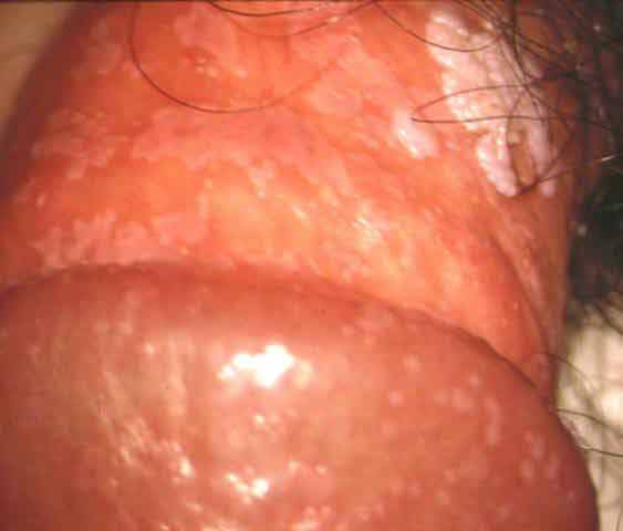 Operazione su un pene in linea