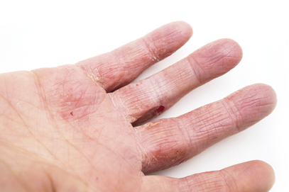 Dermatite di atopic del bambino 4 anni