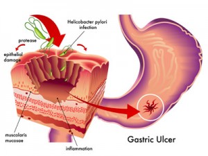 Ulcera 