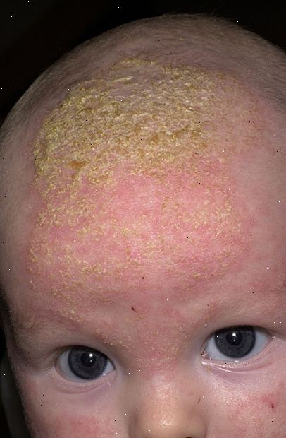 Crosta Lattea: dermatite seborroica infantile, squame