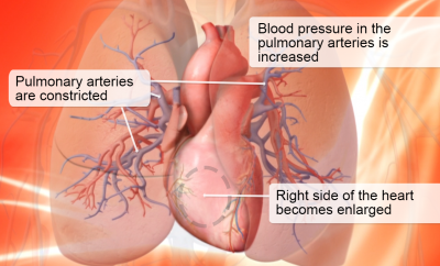 Ipertensione Polmonare