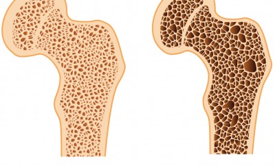 Osteoporosi