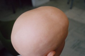Alopecia Areata totale