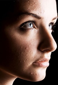 Acne cosmetica Acne cosmetica, primo piano della patologia