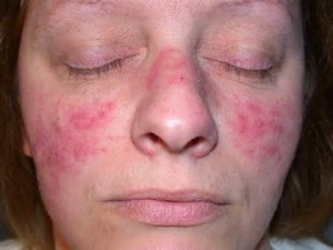 cura per acne rosacea cura per acne rosacea