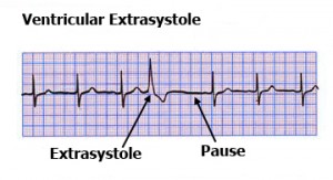 Extrasistole
