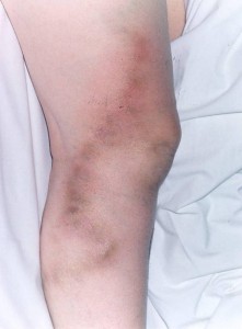 Flebite