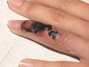 Antrace