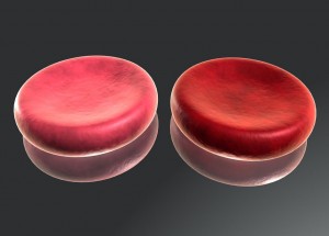 Ipossiemia