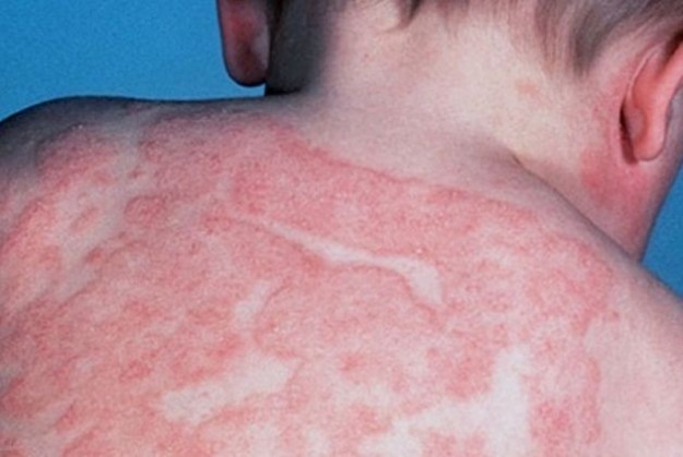 Dermatite e malattie della pelle