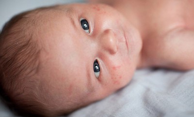 acne-neonatale