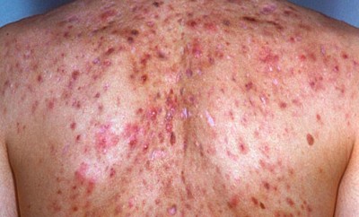 acne-conglobata